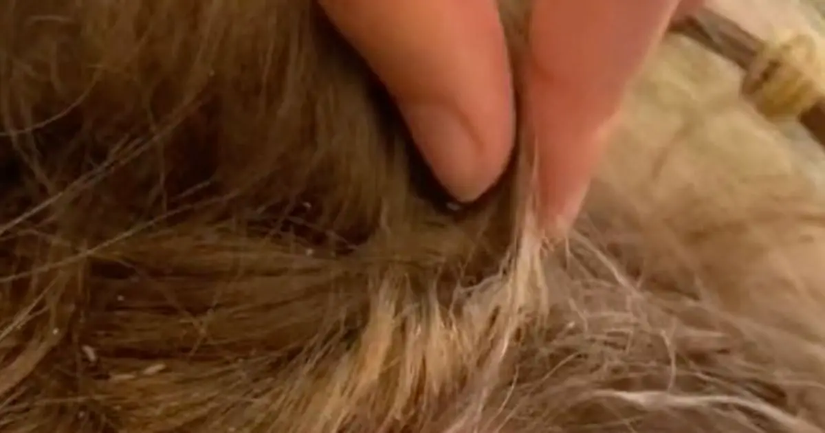 Hairdresser shares horrific lice INFESTATION on girl's head covered in bites