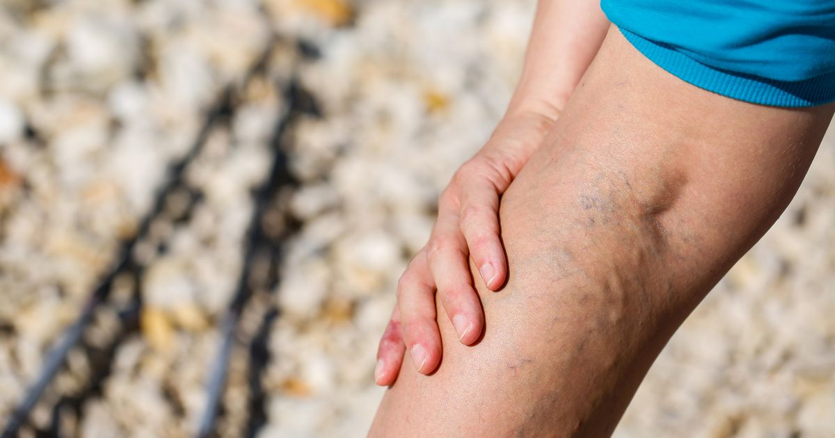 5 early signs of varicose veins and how they are caused