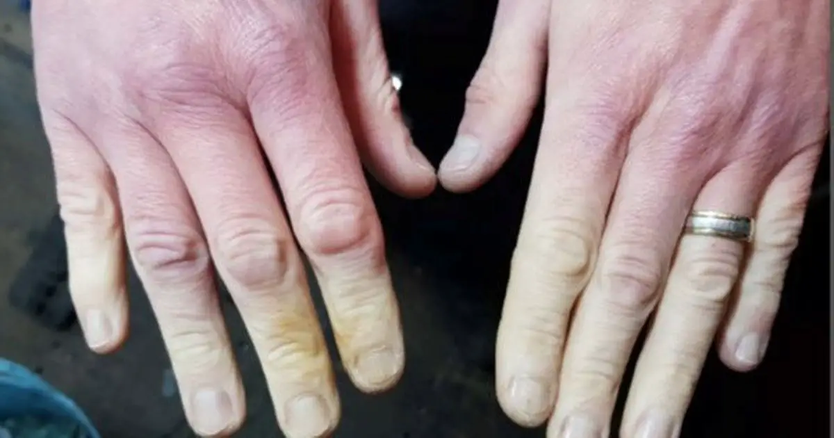 Health condition causes fingers to change colour - what is Raynaud's, symptoms and how to prevent it?