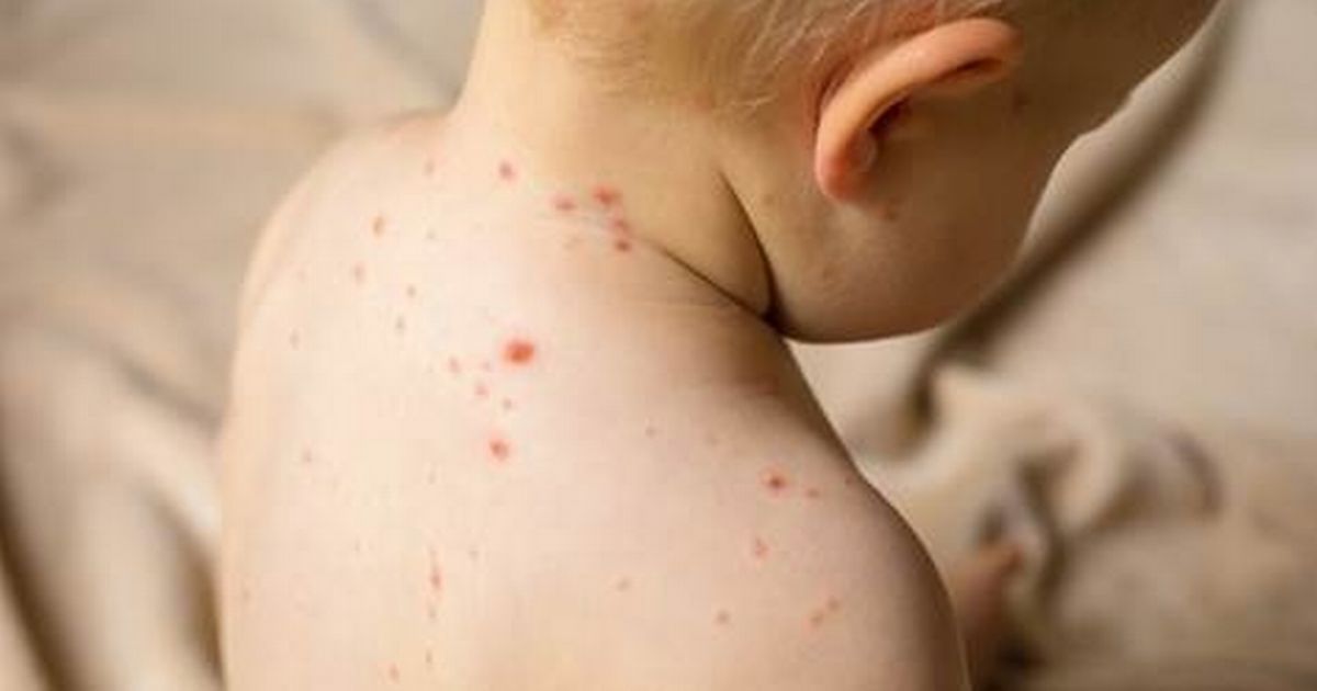 What is the MMR jab and is it safe? Health chiefs issue measles warning as vaccine rate falls